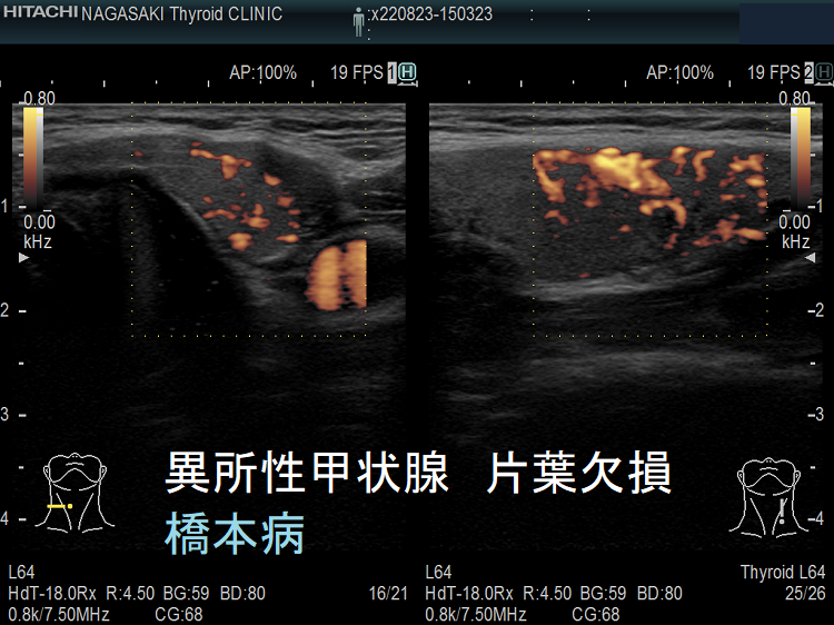 異所性甲状腺・片葉欠損症(半葉欠損症)・橋本病の合併(ドプラーモード) 異所性甲状腺・片葉欠損症(半葉欠損症)・橋本病の合併(ドプラーモード)