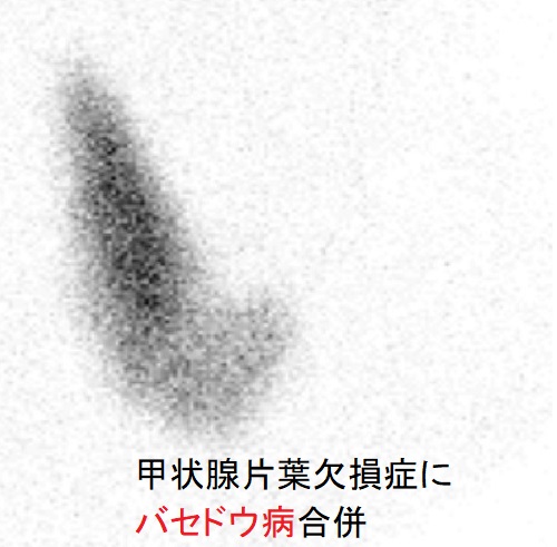 甲状腺片葉欠損症にバセドウ病合併 123-Iシンチグラフィー 甲状腺片葉欠損症にバセドウ病合併 123-Iシンチグラフィー