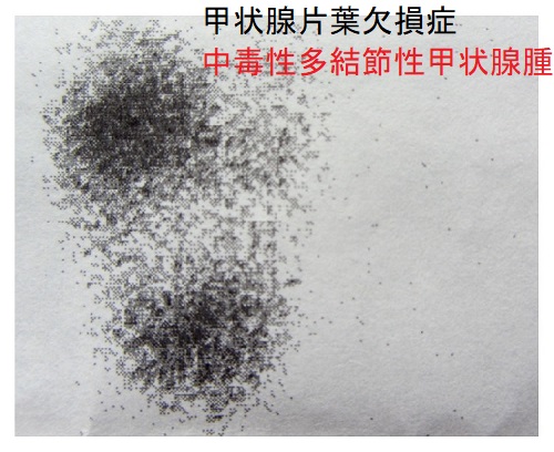 甲状腺片葉欠損症(半葉欠損症)に中毒性多結節性甲状腺腫合併 123-Iシンチグラフィー 甲状腺片葉欠損症(半葉欠損症)に中毒性多結節性甲状腺腫合併 123-Iシンチグラフィー