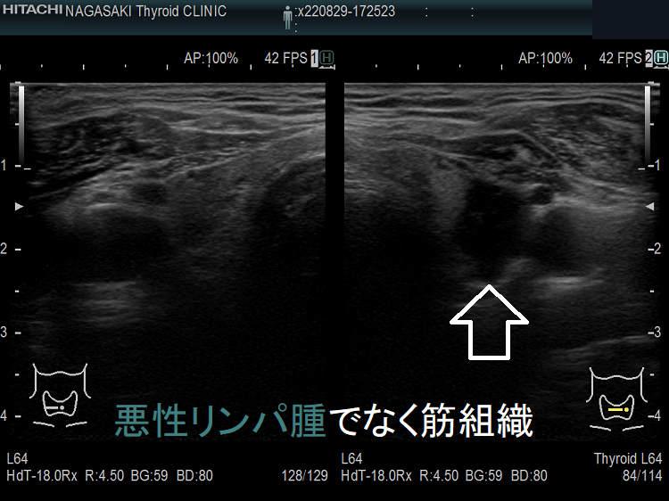 甲状腺悪性リンパ腫でなく頚筋組織 超音波(エコー)画像 甲状腺悪性リンパ腫でなく頚筋組織 超音波(エコー)画像