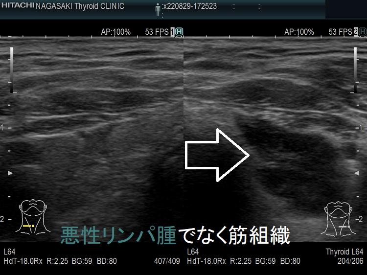 甲状腺悪性リンパ腫でなく頚筋組織 超音波(エコー)画像(拡大) 甲状腺悪性リンパ腫でなく頚筋組織 超音波(エコー)画像(拡大)
