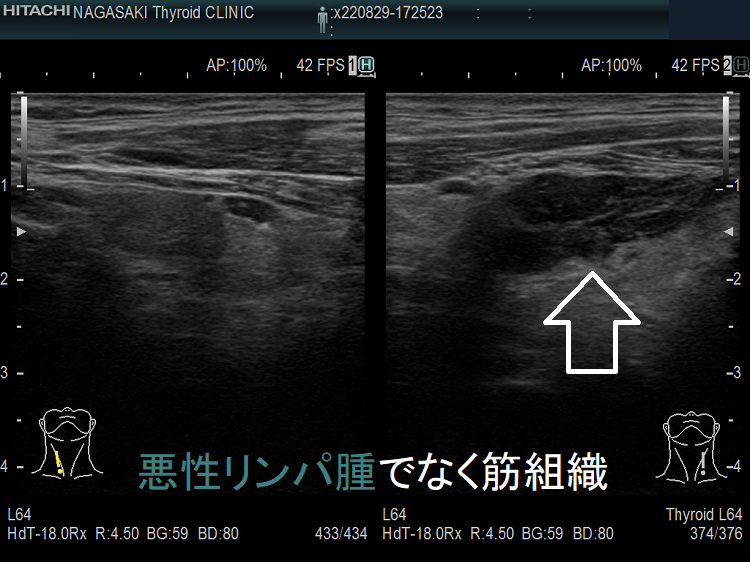 甲状腺悪性リンパ腫でなく頚筋組織 超音波(エコー)画像(垂直断) 甲状腺悪性リンパ腫でなく頚筋組織 超音波(エコー)画像(垂直断)