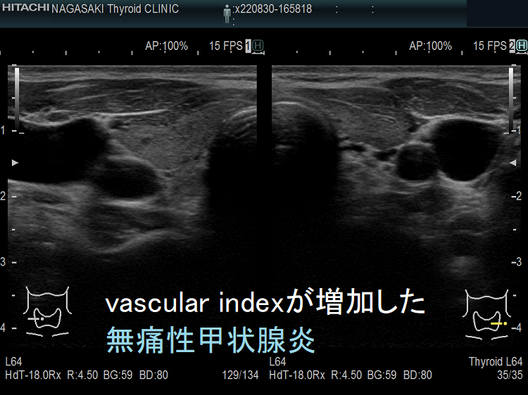 vascular index(血流指数)が増加した無痛性甲状腺炎 Bモード画像 vascular index(血流指数)が増加した無痛性甲状腺炎 Bモード画像