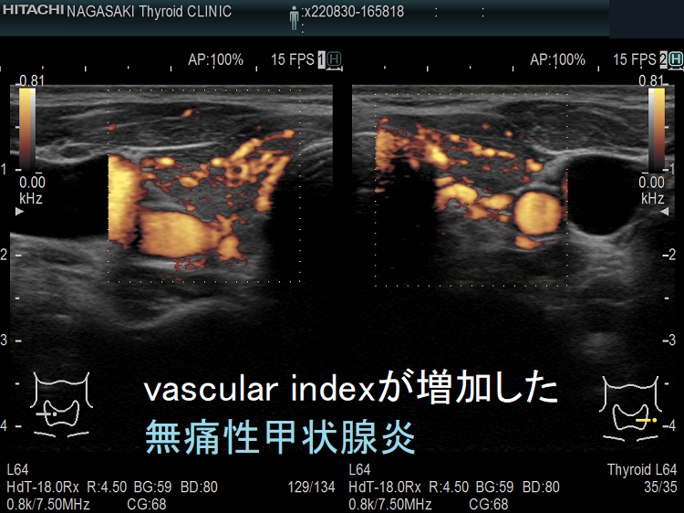 vascular index(血流指数)が増加した急性期の無痛性甲状腺炎のドプラーモード vascular index(血流指数)が増加した急性期の無痛性甲状腺炎のドプラーモード