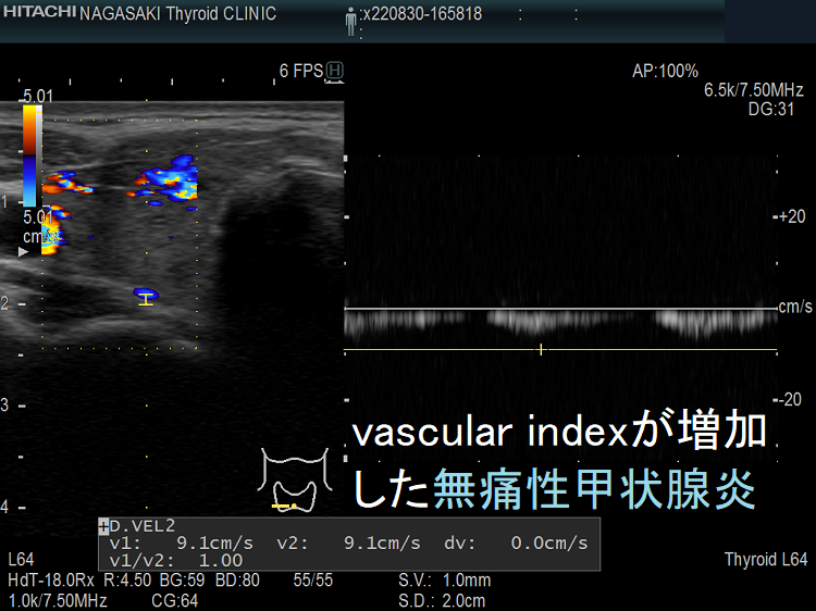 vascular index(血流指数)が増加した急性期の無痛性甲状腺炎の下甲状腺動脈の収縮期最大血流速度(ITA-PSV) vascular index(血流指数)が増加した急性期の無痛性甲状腺炎の下甲状腺動脈の収縮期最大血流速度(ITA-PSV)