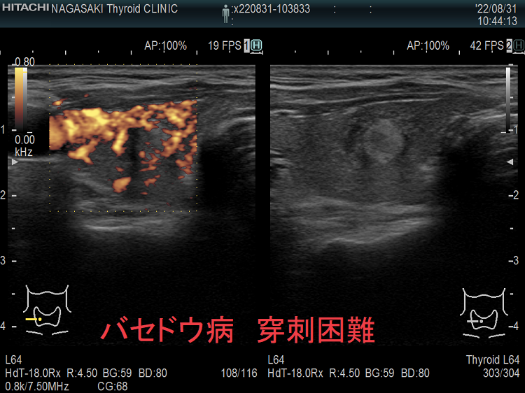 バセドウ病合併甲状腺腫瘍 穿刺困難 バセドウ病合併甲状腺腫瘍 穿刺困難