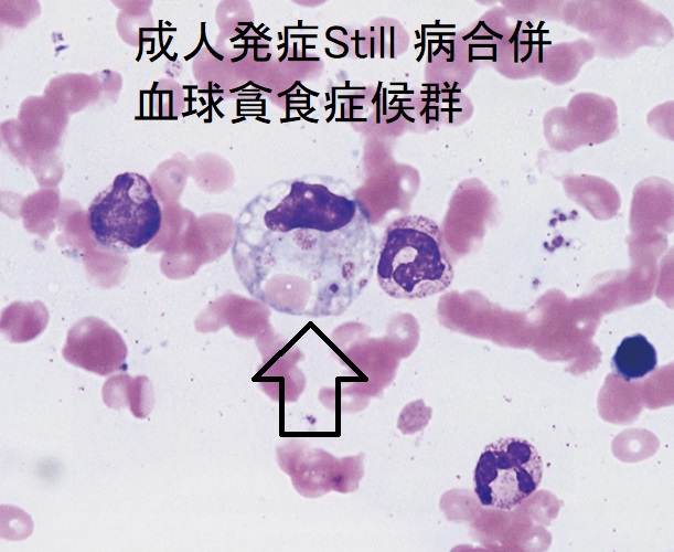 成人発症Still 病に続発した血球貪食症候群 成人発症Still 病に続発した血球貪食症候群