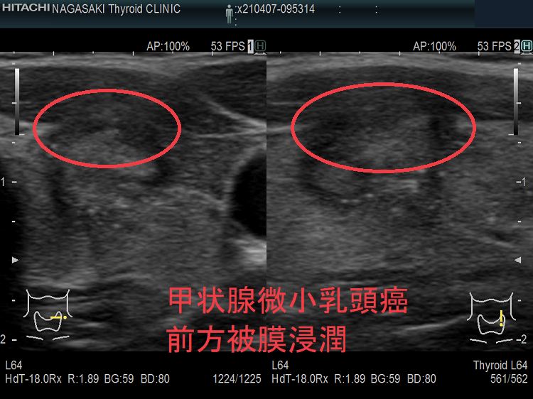 甲状腺微小乳頭癌 前方被膜浸潤 超音波(エコー)画像 甲状腺微小乳頭癌 前方被膜浸潤 超音波(エコー)画像