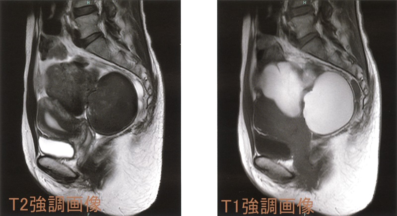 両側卵巣チョコレート嚢胞 MRI画像 両側卵巣チョコレート嚢胞 MRI画像
