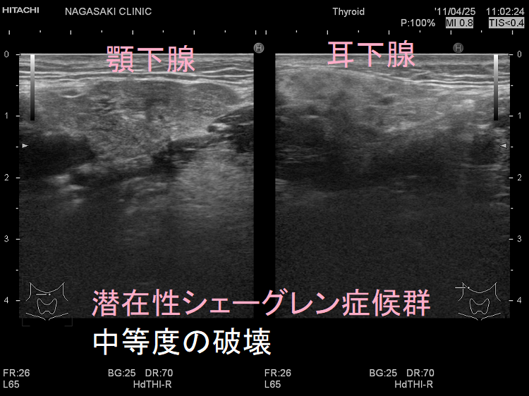 潜在性シェーグレン症候群(顎下腺、耳下腺 中等度の破壊) 潜在性シェーグレン症候群(顎下腺、耳下腺 中等度の破壊)