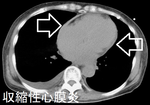 収縮性心膜炎 CT 画像 収縮性心膜炎 CT 画像