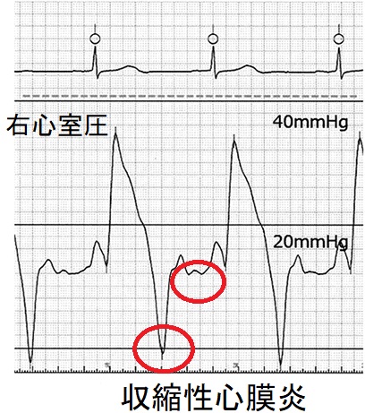 収縮性心膜炎 右心カテーテル 収縮性心膜炎 右心カテーテル
