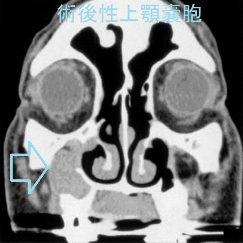 右術後性上顎嚢胞 CT画像 右術後性上顎嚢胞 CT画像
