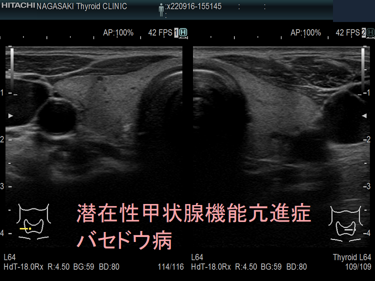 潜在性甲状腺機能亢進症 バセドウ病 超音波エコー画像 潜在性甲状腺機能亢進症 バセドウ病 超音波エコー画像