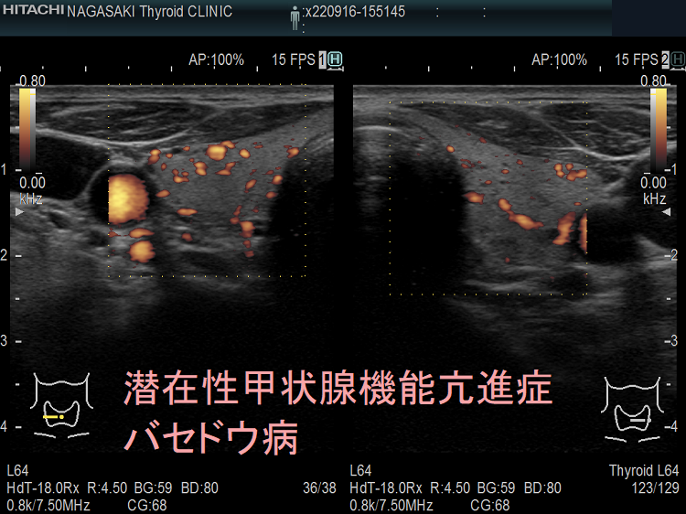 潜在性甲状腺機能亢進症 バセドウ病 超音波エコー画像 ドプラーモード 潜在性甲状腺機能亢進症 バセドウ病 超音波エコー画像 ドプラーモード