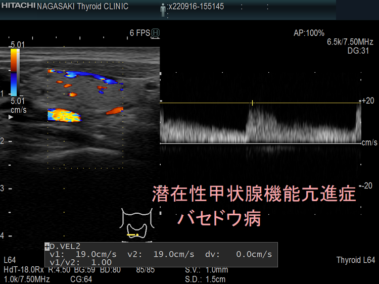 潜在性甲状腺機能亢進症 バセドウ病 超音波エコー画像 下甲状腺動脈収縮期最大血流速度(ITA-PSV) 潜在性甲状腺機能亢進症 バセドウ病 超音波エコー画像 下甲状腺動脈収縮期最大血流速度(ITA-PSV)