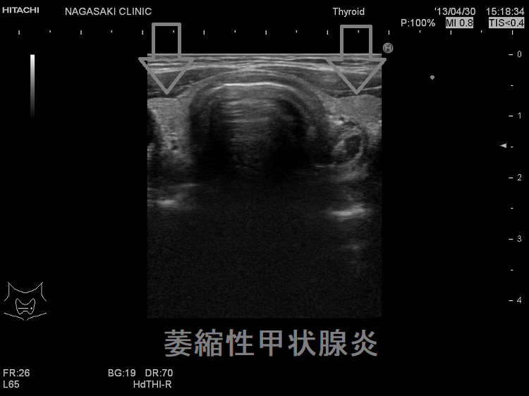 萎縮性甲状腺炎・バセドウ病に移行・橋本病との鑑別[甲状腺機能 萎縮性甲状腺炎・バセドウ病に移行・橋本病との鑑別[甲状腺機能