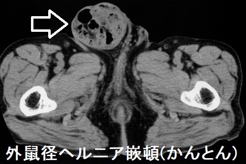 外鼠径ヘルニア嵌頓(かんとん) 外鼠径ヘルニア嵌頓(かんとん)