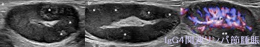 IgG4関連リンパ節腫脹 IgG4関連リンパ節腫脹