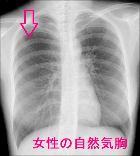 女性の自然気胸 女性の自然気胸