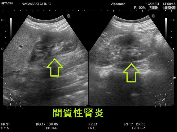 間質性腎炎 超音波(エコー)画像 間質性腎炎 超音波(エコー)画像