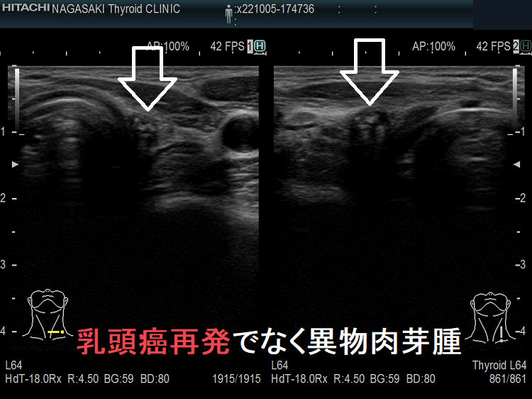 甲状腺乳頭癌再発でなく異物肉芽腫 超音波(エコー)画像 甲状腺乳頭癌再発でなく異物肉芽腫 超音波(エコー)画像
