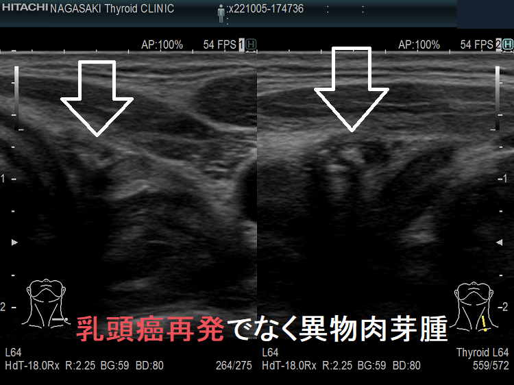 異物肉芽腫 超音波(エコー)画像 (拡大) 異物肉芽腫 超音波(エコー)画像 (拡大)
