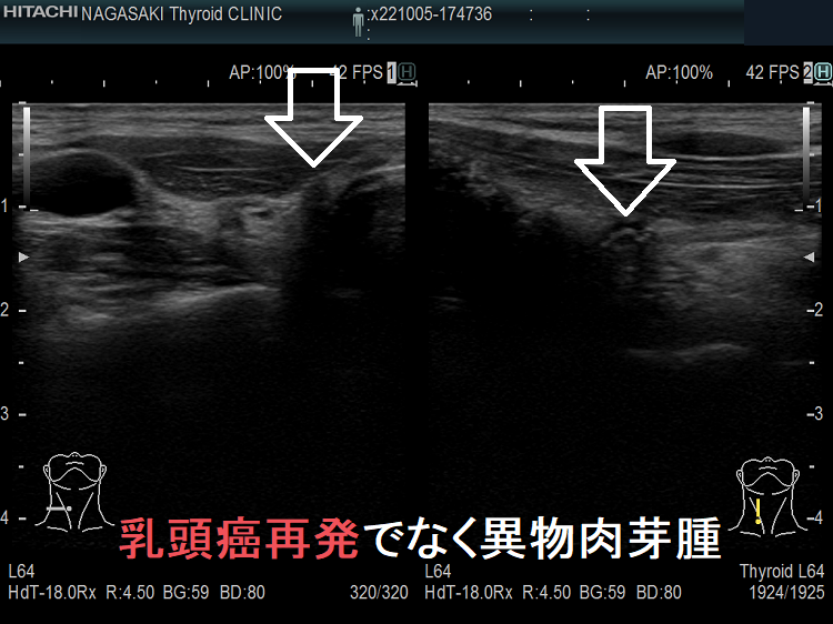 異物肉芽腫 超音波(エコー)画像 異物肉芽腫 超音波(エコー)画像