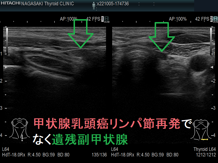 甲状腺乳頭癌リンパ節再発でなく遺残副甲状腺 甲状腺乳頭癌リンパ節再発でなく遺残副甲状腺