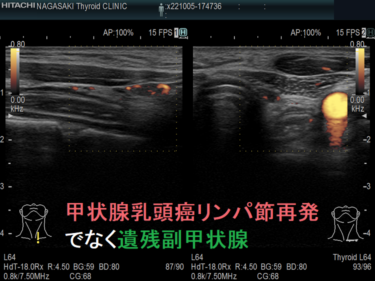 甲状腺乳頭癌リンパ節再発でなく遺残副甲状腺 ドプラーモード 甲状腺乳頭癌リンパ節再発でなく遺残副甲状腺 ドプラーモード