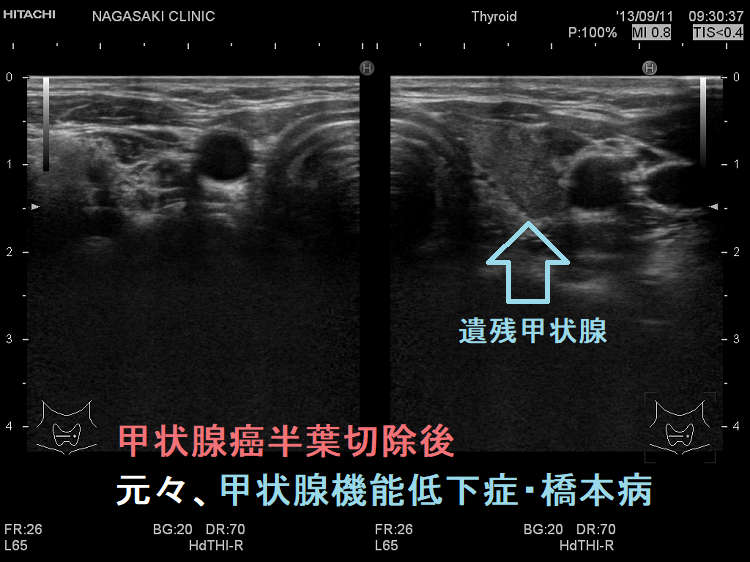 甲状腺癌半葉切除後、元々、甲状腺機能低下症・橋本病 甲状腺癌半葉切除後、元々、甲状腺機能低下症・橋本病