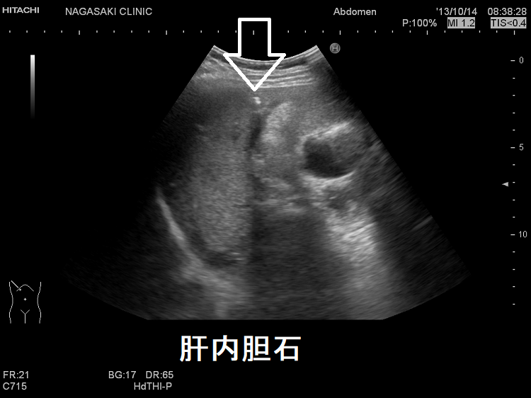 肝内胆石 超音波(エコー)画像 肝内胆石 超音波(エコー)画像