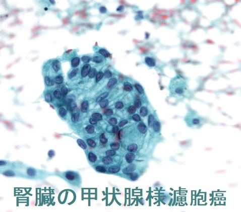 腎臓の甲状腺様濾胞癌 腎臓の甲状腺様濾胞癌