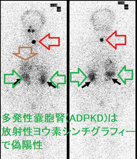 多発性嚢胞腎(ADPKD)は、放射性ヨウ素シンチグラフィーで偽陽性 多発性嚢胞腎(ADPKD)は、放射性ヨウ素シンチグラフィーで偽陽性