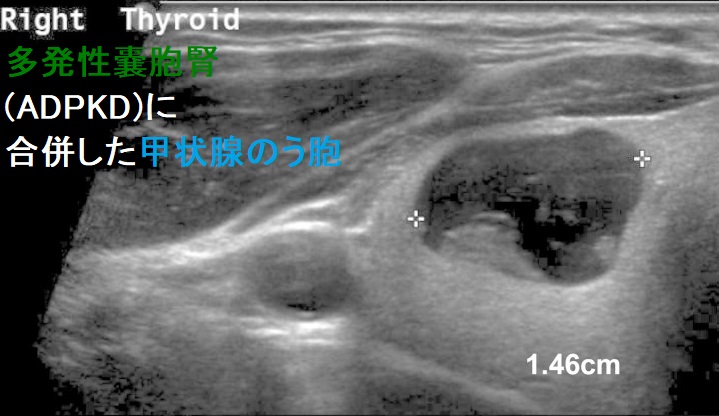 多発性嚢胞腎(ADPKD)に合併した甲状腺のう胞1 多発性嚢胞腎(ADPKD)に合併した甲状腺のう胞1