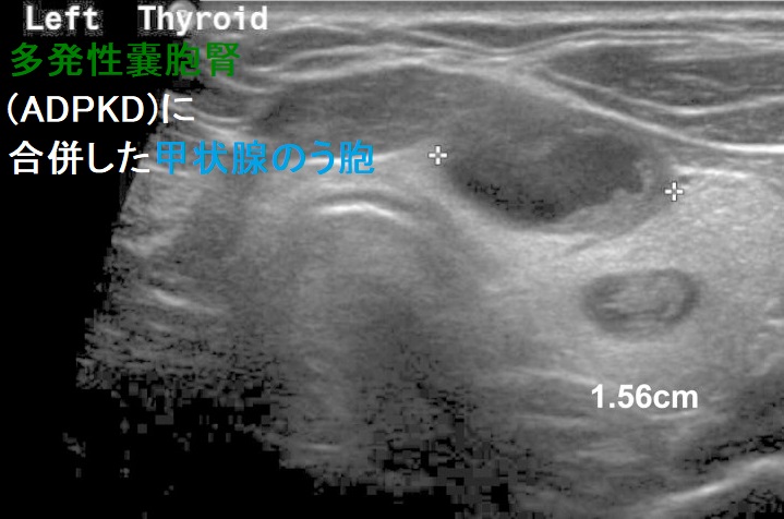 多発性嚢胞腎(ADPKD)に合併した甲状腺のう胞 多発性嚢胞腎(ADPKD)に合併した甲状腺のう胞