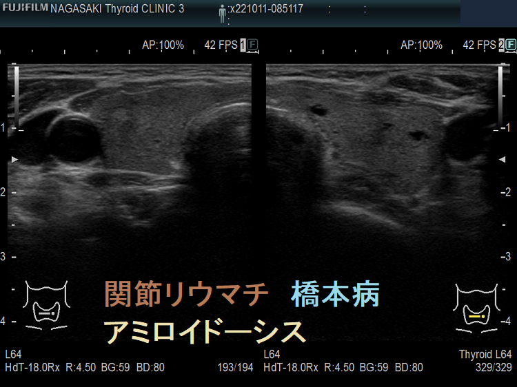 関節リウマチ 橋本病 アミロイドーシス合併 関節リウマチ 橋本病 アミロイドーシス合併