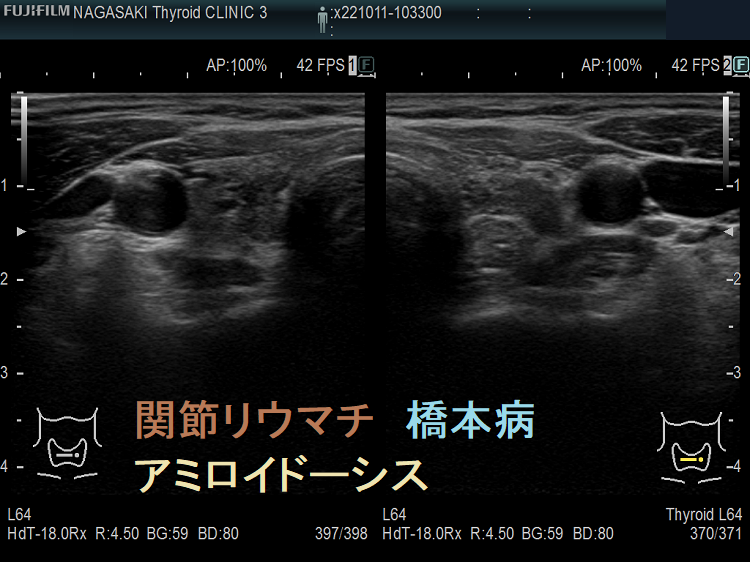 関節リウマチ 橋本病 アミロイドーシス合併2 関節リウマチ 橋本病 アミロイドーシス合併2