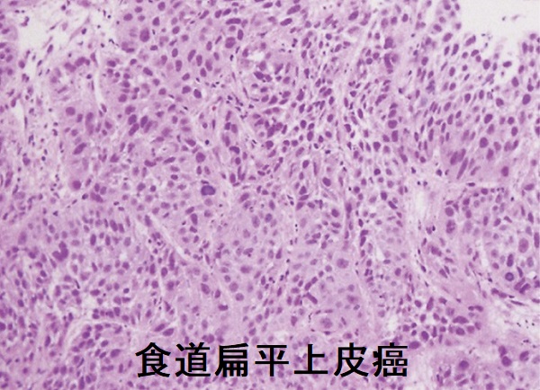 進行食道扁平上皮癌 組織像 進行食道扁平上皮癌 組織像