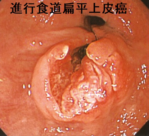 進行食道扁平上皮癌 内視鏡画像 進行食道扁平上皮癌 内視鏡画像