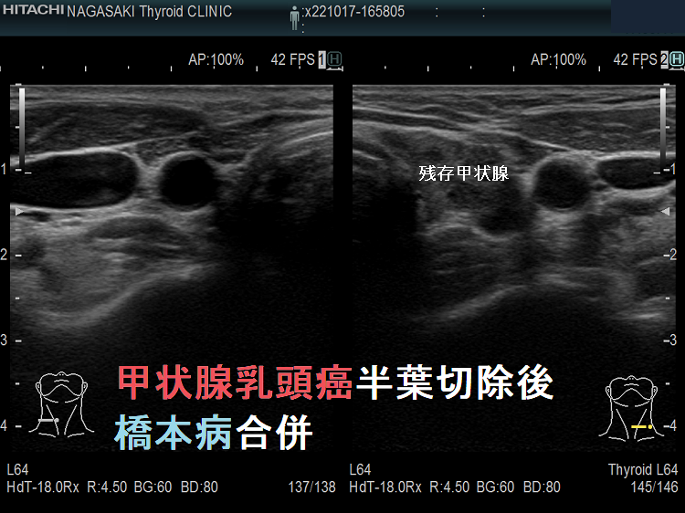 甲状腺乳頭癌半葉切除後 橋本病合併 甲状腺乳頭癌半葉切除後 橋本病合併