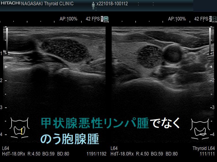 甲状腺悪性リンパ腫でなく、のう胞腺腫 甲状腺悪性リンパ腫でなく、のう胞腺腫