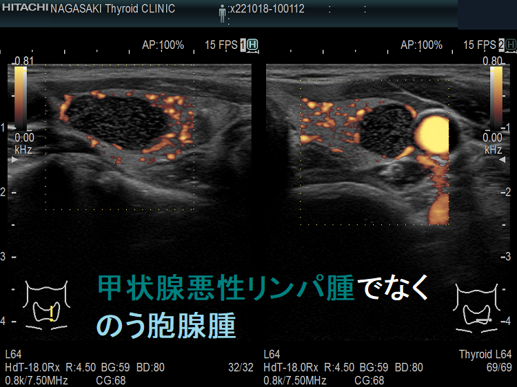 甲状腺悪性リンパ腫でなく、のう胞腺腫 ドプラーモード 甲状腺悪性リンパ腫でなく、のう胞腺腫 ドプラーモード