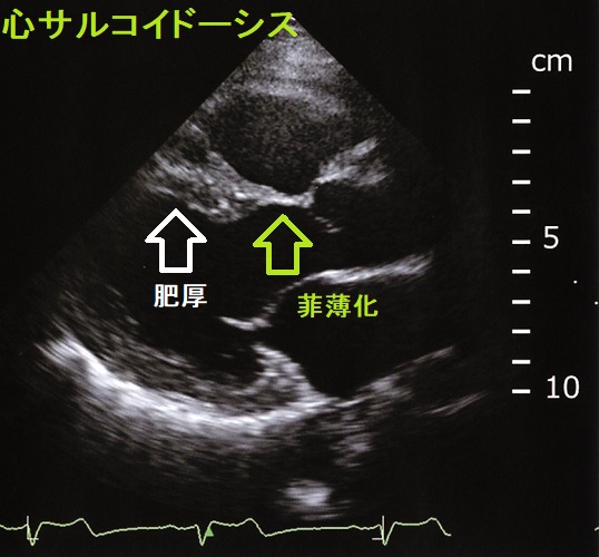 心サルコイドーシス 心エコー 心サルコイドーシス 心エコー