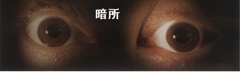 右眼外傷性視神経症 暗所 右眼外傷性視神経症 暗所