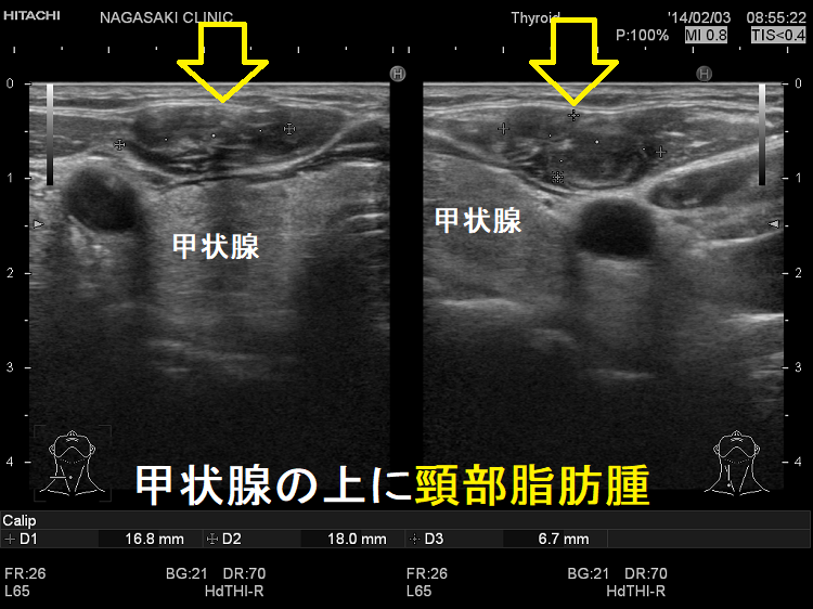 甲状腺の上に頸部脂肪腫 甲状腺の上に頸部脂肪腫