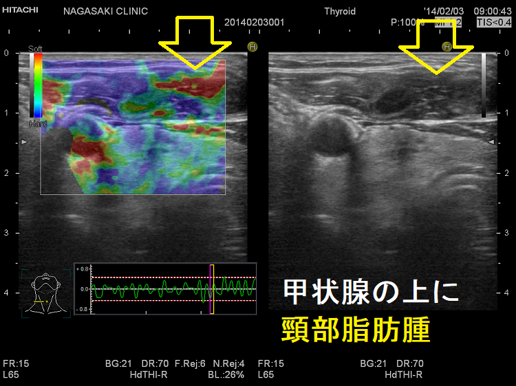 甲状腺の上に頸部脂肪腫 超音波(エコー)画像 エラストグラフィー 甲状腺の上に頸部脂肪腫 超音波(エコー)画像 エラストグラフィー