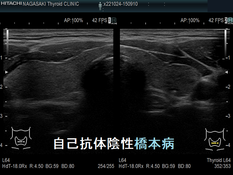 自己抗体陰性橋本病 超音波(エコー)画像 自己抗体陰性橋本病 超音波(エコー)画像