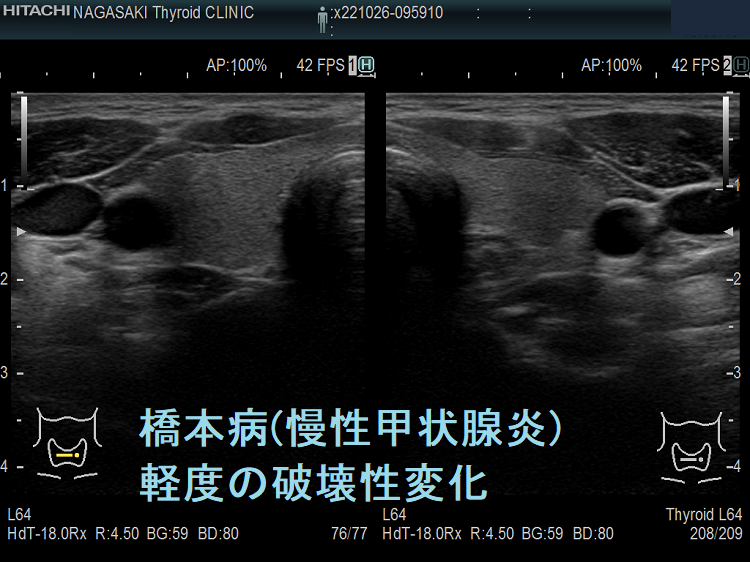 橋本病(慢性甲状腺炎)軽度の破壊性変化 超音波(エコー)画像 橋本病(慢性甲状腺炎)軽度の破壊性変化 超音波(エコー)画像