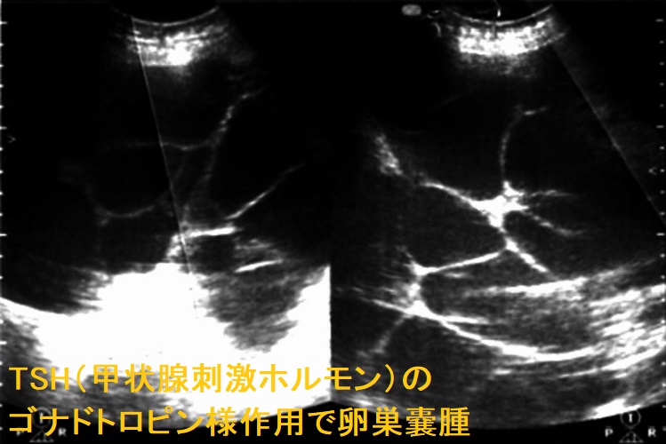 TSH(甲状腺刺激ホルモン)のゴナドトロピン様作用で卵巣嚢腫 TSH(甲状腺刺激ホルモン)のゴナドトロピン様作用で卵巣嚢腫